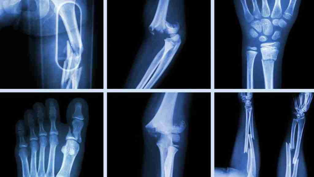 Crystals for Bone Healing